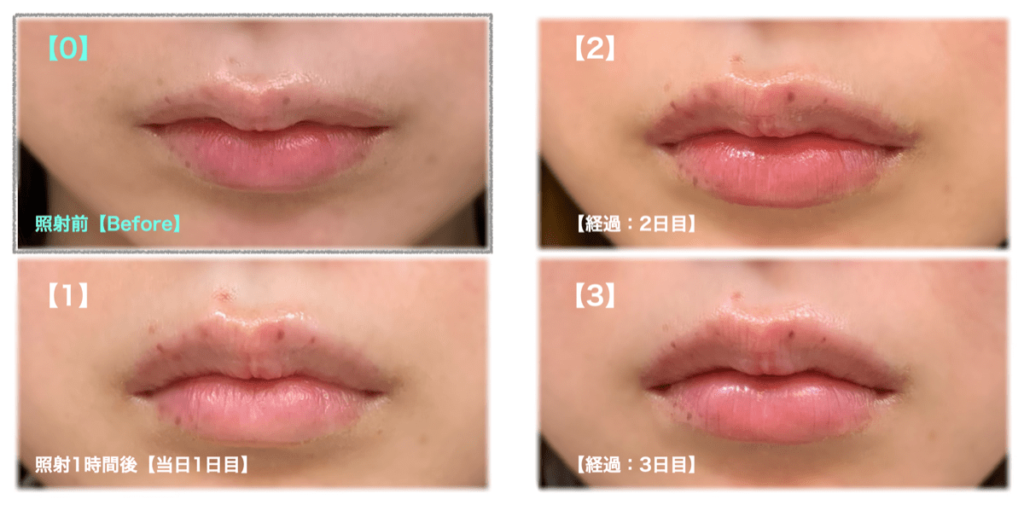 ピコシュア 唇のシミを消すピコスポットレーザー 体験レポート ハクケン